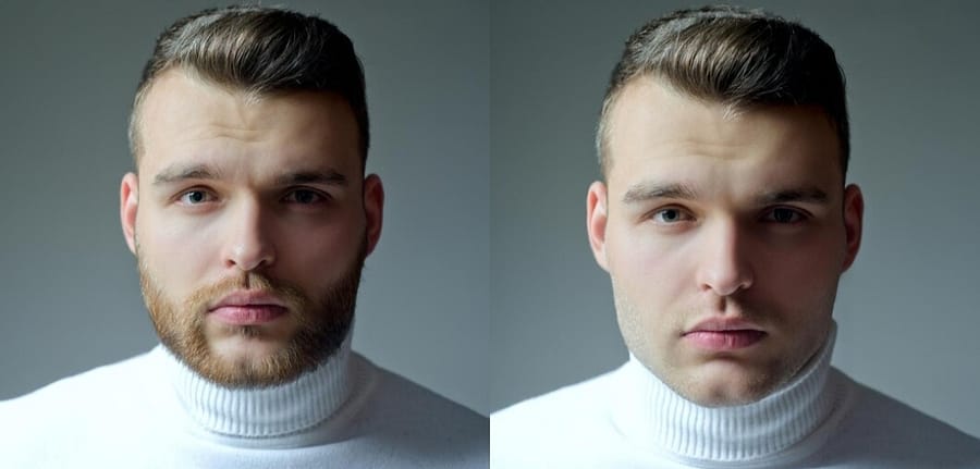 27. “Close-up image of a man’s face showing denser beard after using Minoxidil for 2 months”